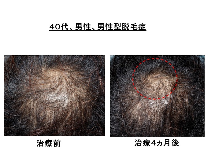 汎発性脱毛　病院